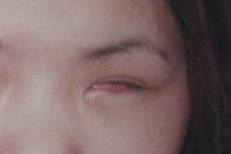 眼球破裂恢复后图