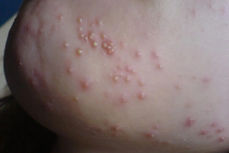 脓疱疮图
