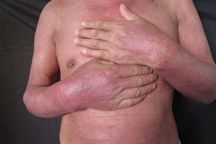 皮肌炎皮肤异色症图 皮肌炎皮肤异色症图