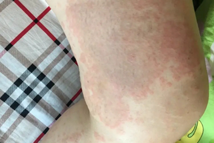 妊娠多形疹症状图 妊娠多形疹症状图