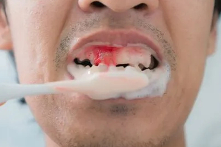 牙周炎早期牙龈出血图