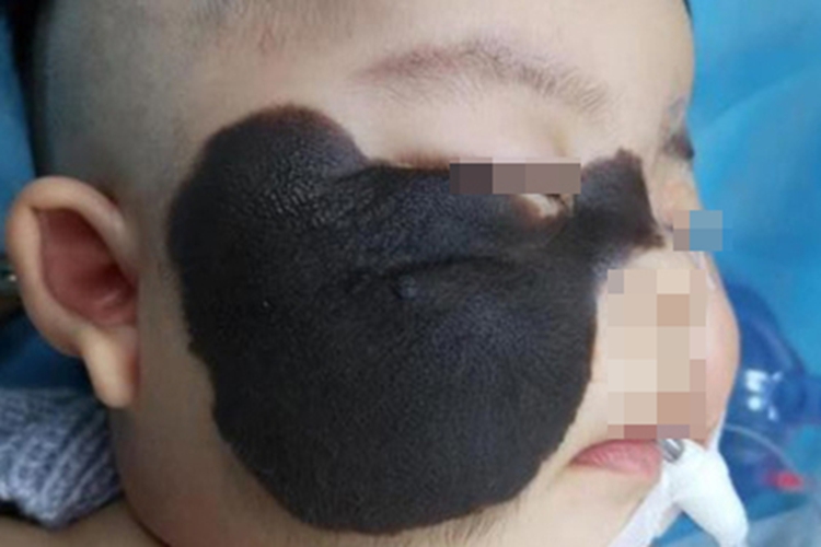 兽皮痣面部黑斑图