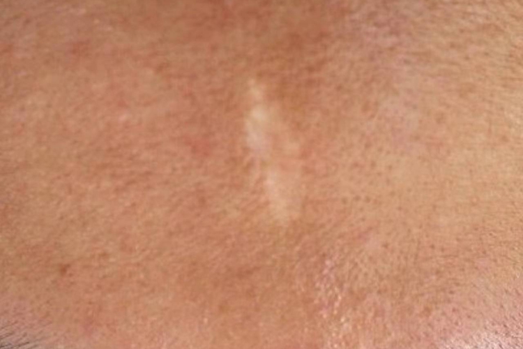 伤口愈合接近肤色图 伤口愈合接近肤色图