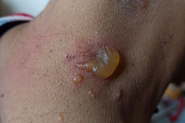 隐翅虫皮炎红斑水疱图 隐翅虫皮炎红斑水疱图