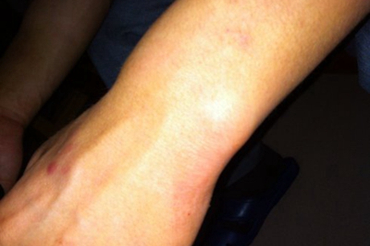 扭伤手腕症状图