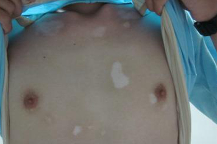 胸前白癜风长斑图 胸前白癜风长斑图