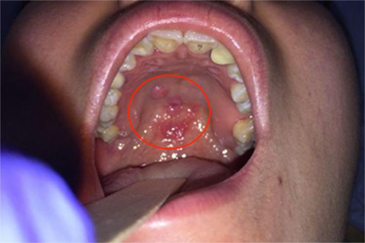 二期口腔梅毒口腔黏膜充血图