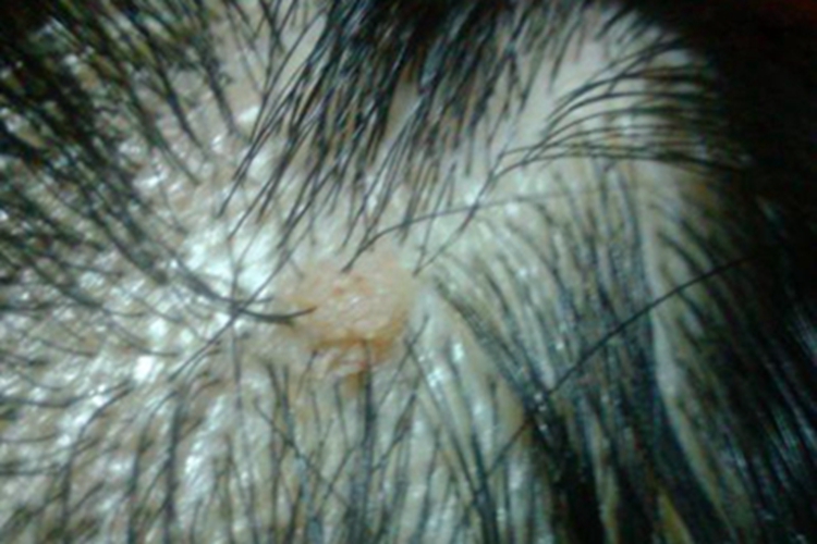 疣状角化不良瘤头皮症状图 疣状角化不良瘤头皮症状图