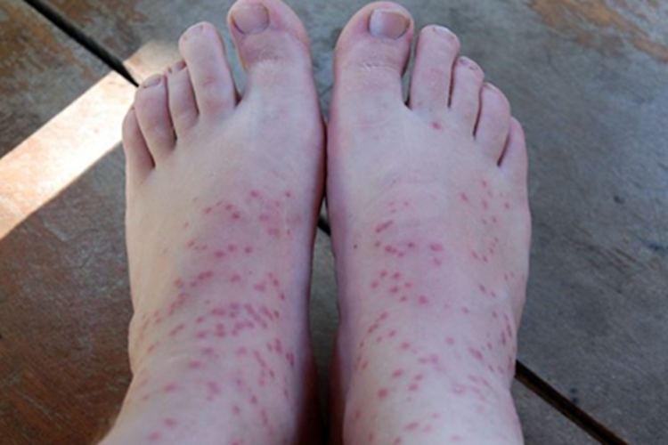 恙螨皮炎脚背症状图 恙螨皮炎脚背症状图