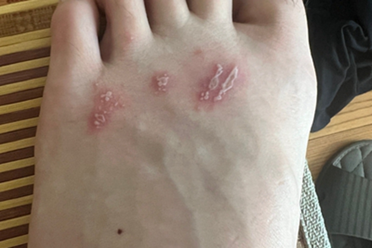 隐翅虫皮炎脚背红斑图 隐翅虫皮炎脚背红斑图