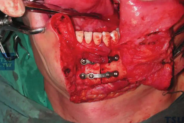 下颌骨骨折固定图