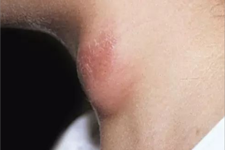 瘰疬性皮肤结核颈部大包图 瘰疬性皮肤结核颈部大包图