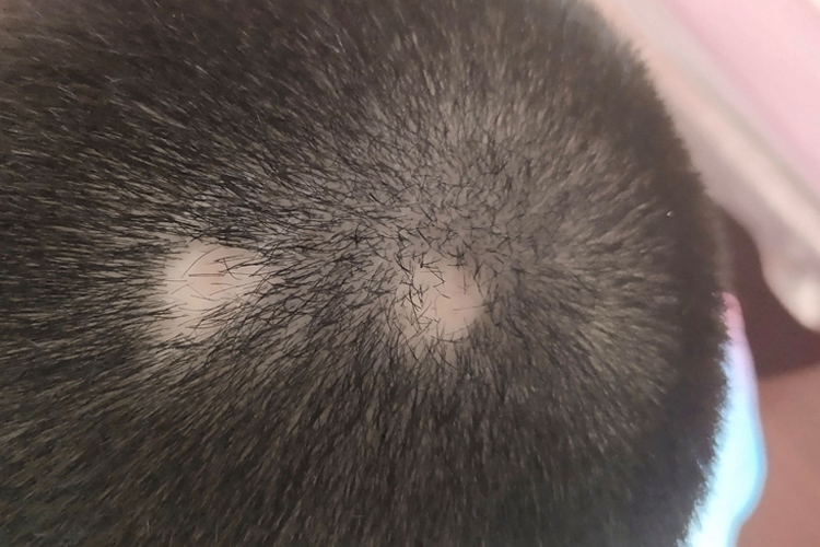 斑秃头皮有两个脱发区图