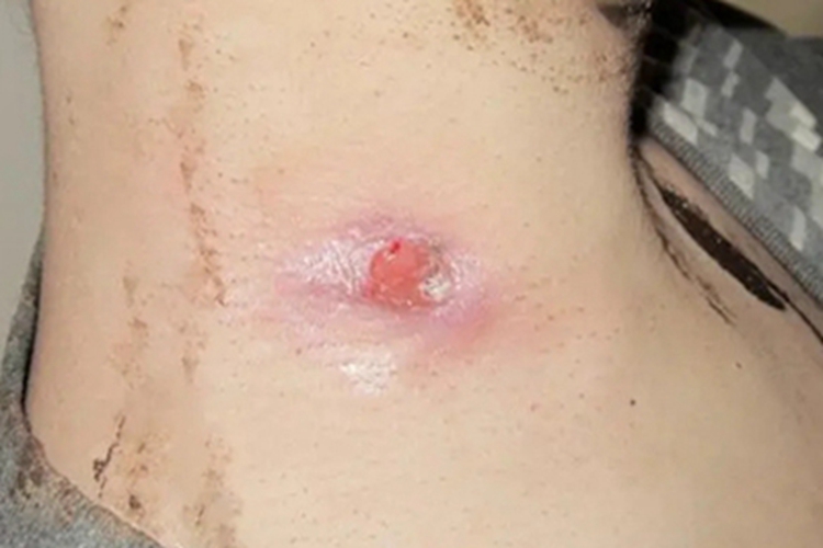 偶遇分枝杆菌感染侧颈溃疡图 偶遇分枝杆菌感染侧颈溃疡图