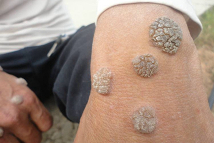 寻常疣样职业性疣赘手腕症状图