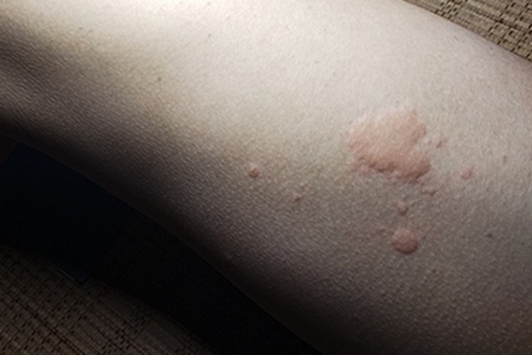 急性自发性荨麻疹腿部风团图