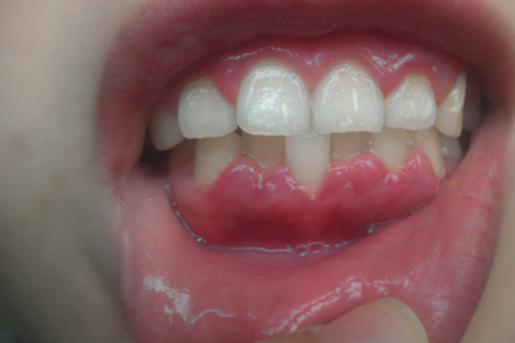 边缘性龈炎牙龈变形图