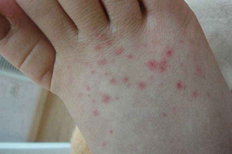 机械性紫癜脚背红点图