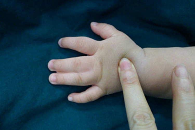 狭颅症手指粘连在一起图 狭颅症手指粘连在一起图