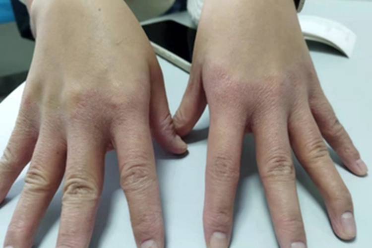 青年成人期特应性皮炎手部症状图