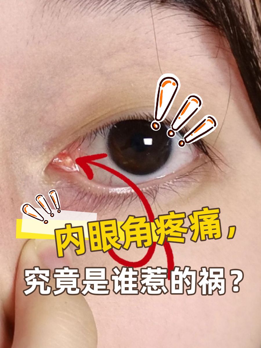 内眼角疼痛，究竟是谁惹的祸？
