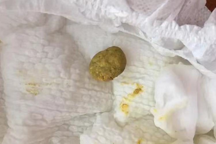 小孩积食大便硬结图
