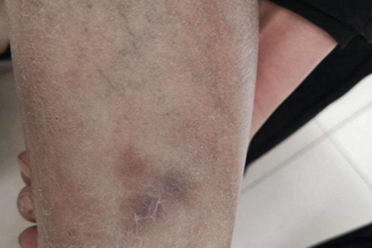 人工性脂膜炎红斑图