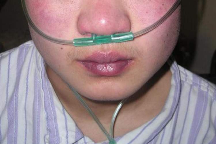 从而出现缺氧,表现为口唇发绀,反复喘息,呼吸困难等症状