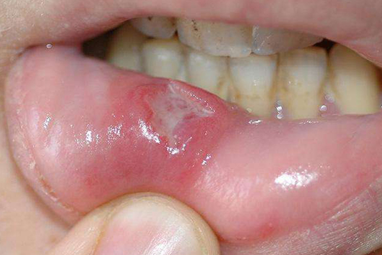 克罗恩病口腔溃疡图
