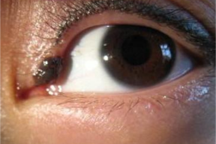 结节型基底细胞瘤眼角结节图 结节型基底细胞瘤眼角结节图