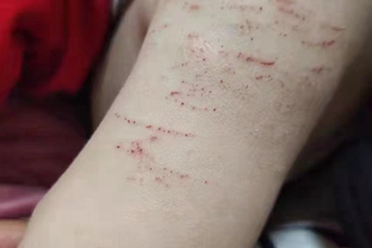人工皮炎胳膊血痂图