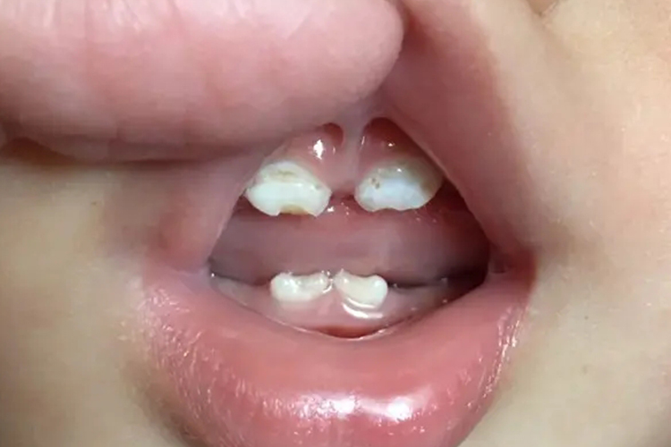 一岁宝宝牙齿发黄腐蚀图 一岁宝宝牙齿发黄腐蚀图