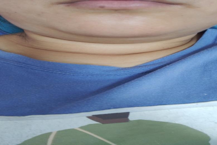 肥胖导致的脖子粗大图