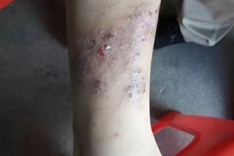 慢性湿疹小腿皮肤粗糙图