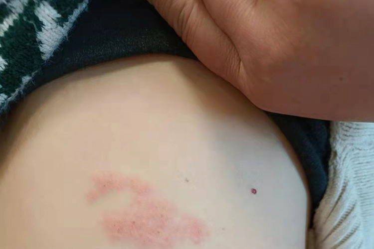 幼儿急疹腹部刚出疹图 幼儿急疹腹部刚出疹图