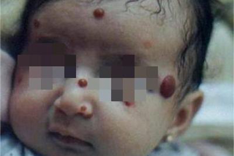 蓝色橡皮疱样痣面部疙瘩图