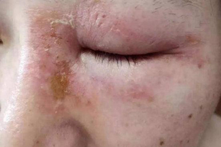 隐翅虫皮炎眼周症状图