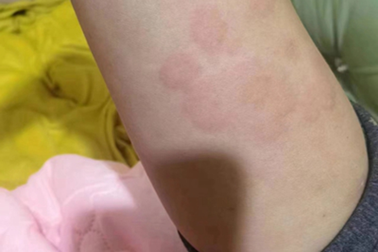 慢性自发性荨麻疹胳膊大红疙瘩图 慢性自发性荨麻疹胳膊大红疙瘩图