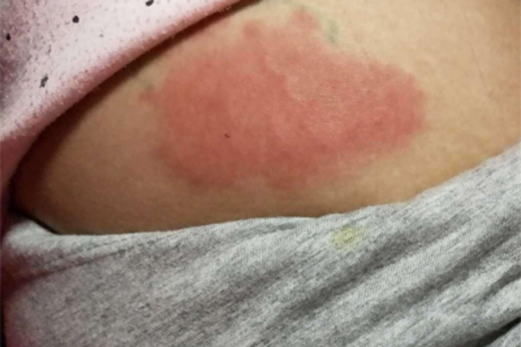 体虱病腰部大片红斑图