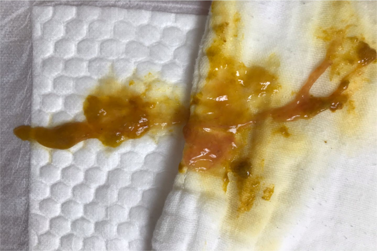 宫颈癌黏液便图