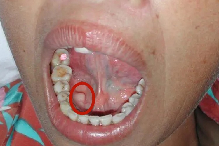 下颌骨舌侧骨隆突图