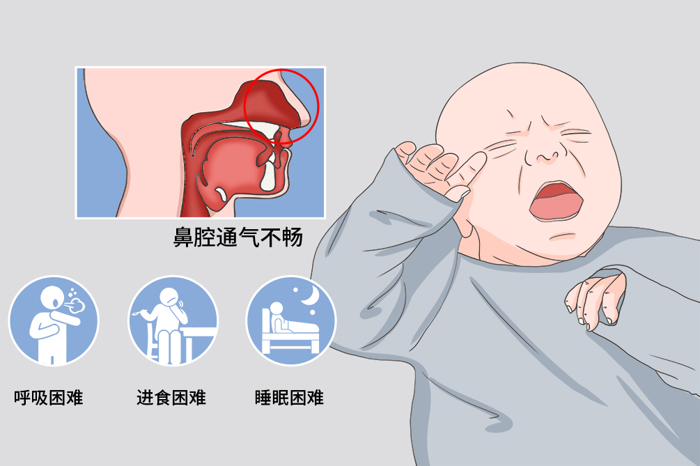 婴儿鼻塞
