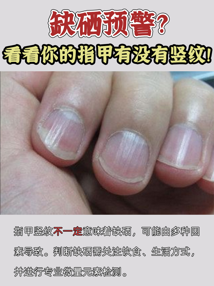 缺硒预警?看看你的指甲有没有竖纹!