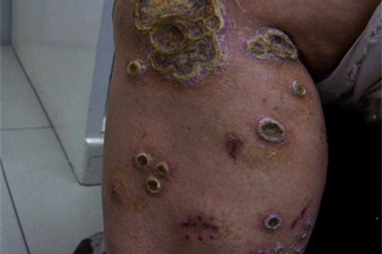 脓疱疮小腿症状图 脓疱疮小腿症状图