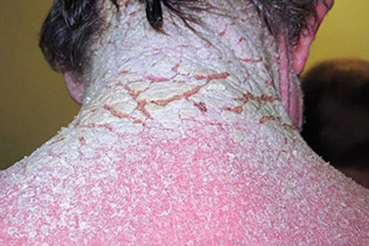 结痂性疥疮后颈脱屑图