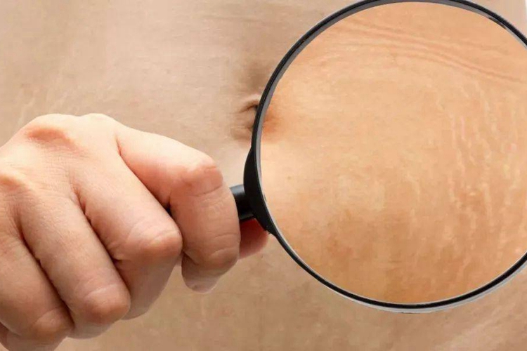 萎缩纹左腹黄白色条纹图