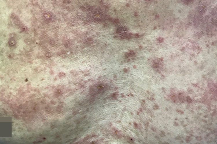 亚急性湿疹胸部红斑图（需打码）