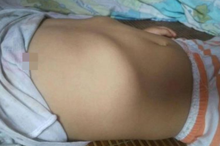 氟骨症肋部畸形图