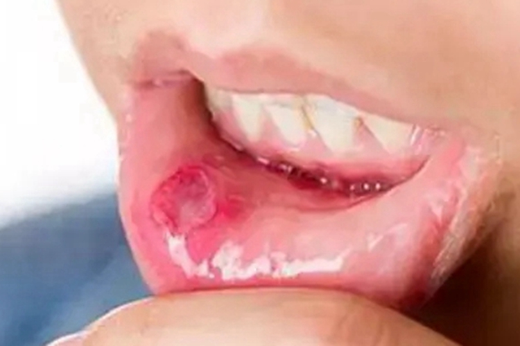 系统性红斑狼疮唇内侧溃疡图 系统性红斑狼疮唇内侧溃疡图