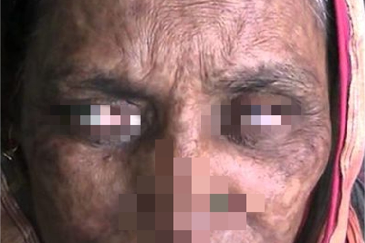 天花面部瘢痕图